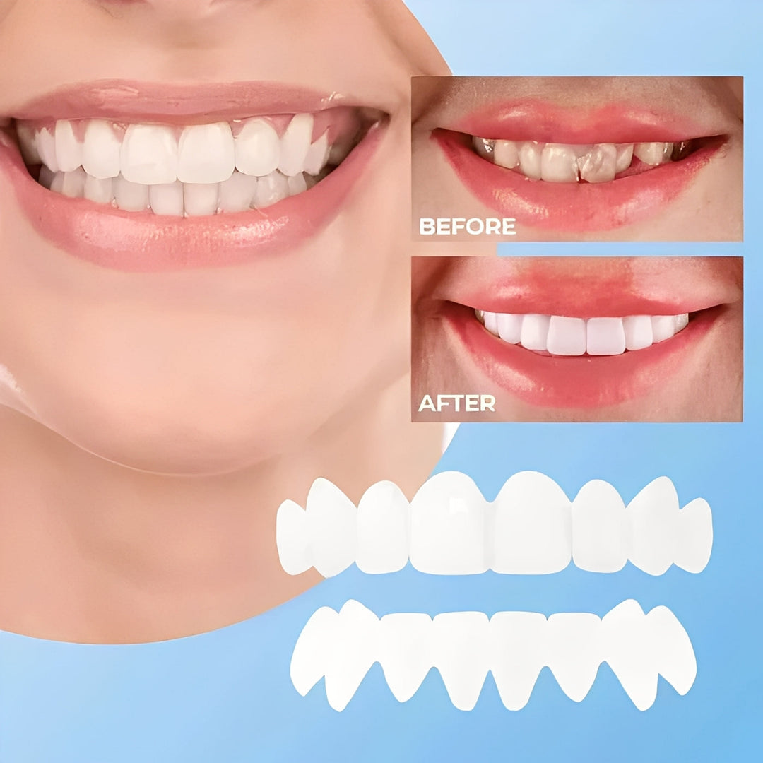 Cosmetic Veneers for Teeth Natural White Finish